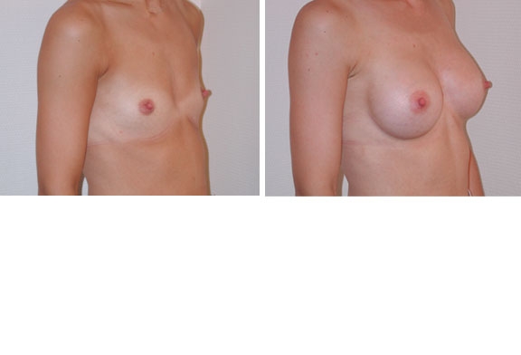 Augmentation mammaire cas n°1 (profil)