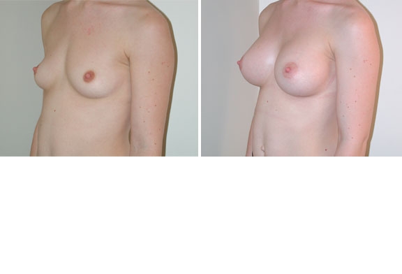 Augmentation mammaire cas n°2 (profil)