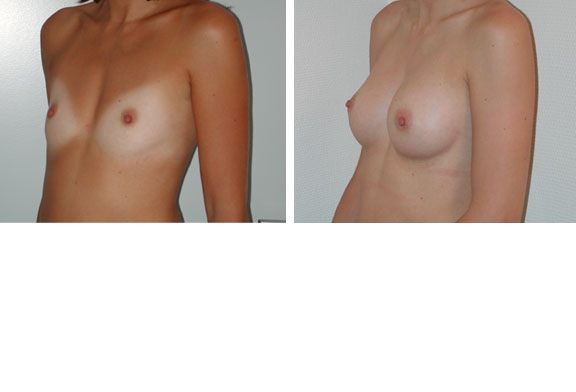 Augmentation mammaire cas n°3 (profil)